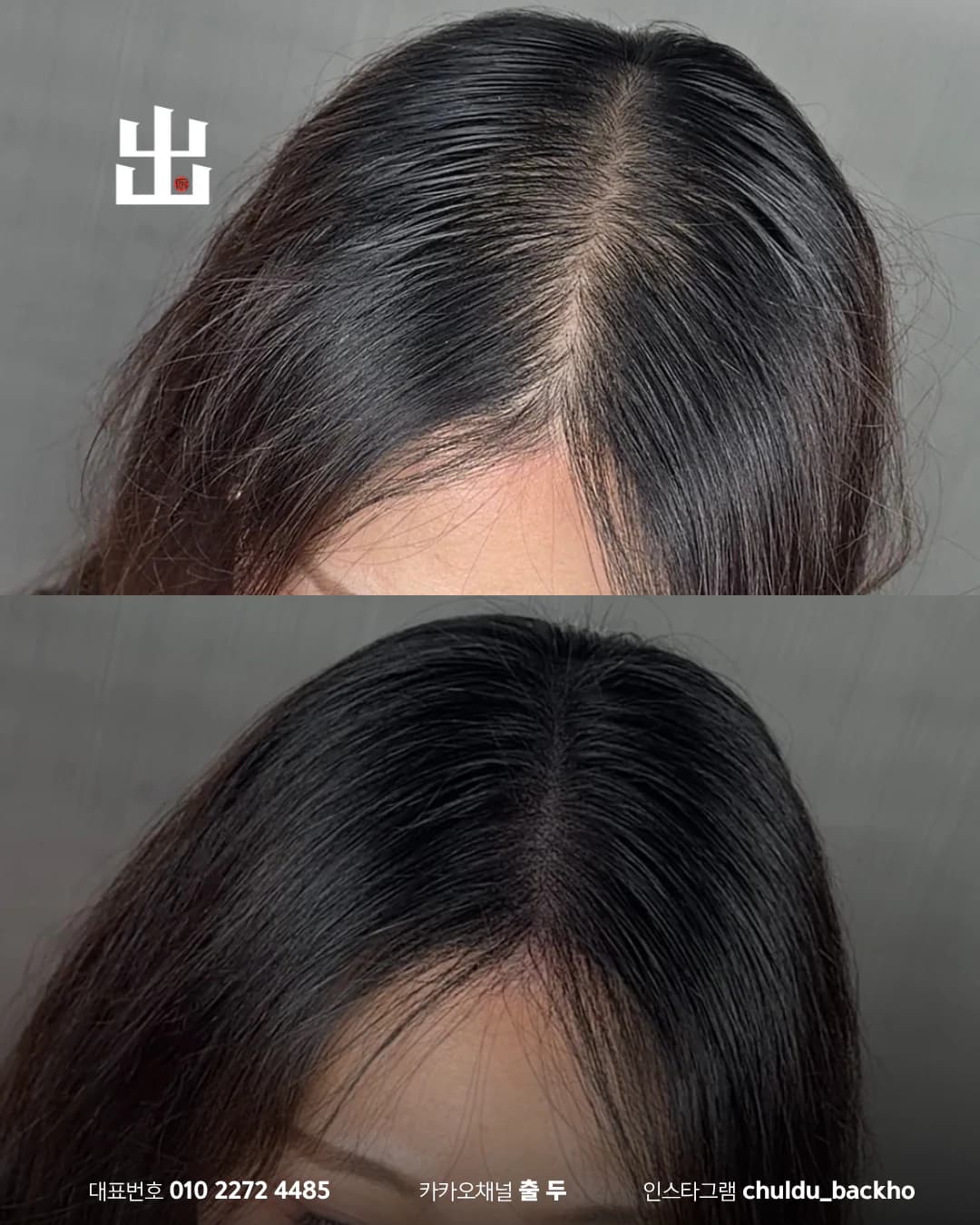 여성 가르마 옆 근접 두피문신 시술 전후 비교