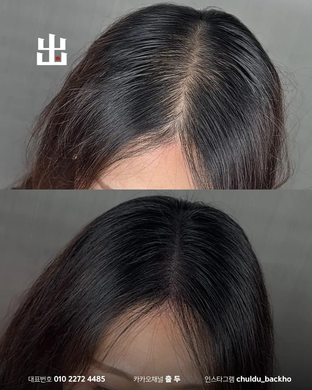 여성 가르마 두피문신 가르마 부위 근접 시술 전후 비교