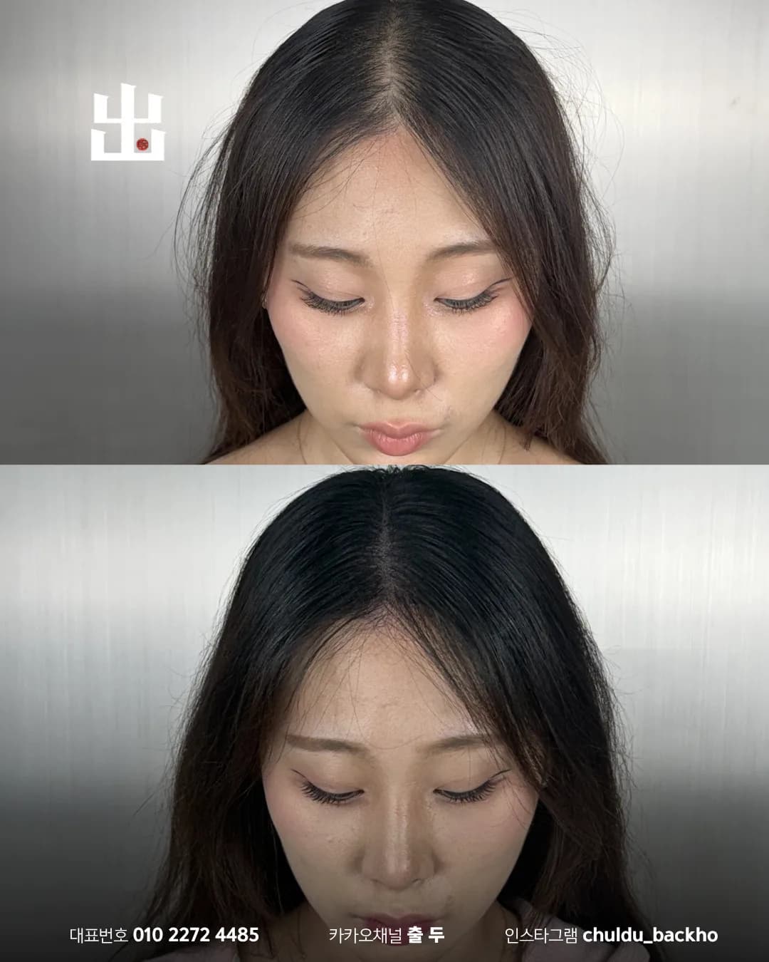 여성 가르마 두피문신 정면에서 본 시술 전후 비교